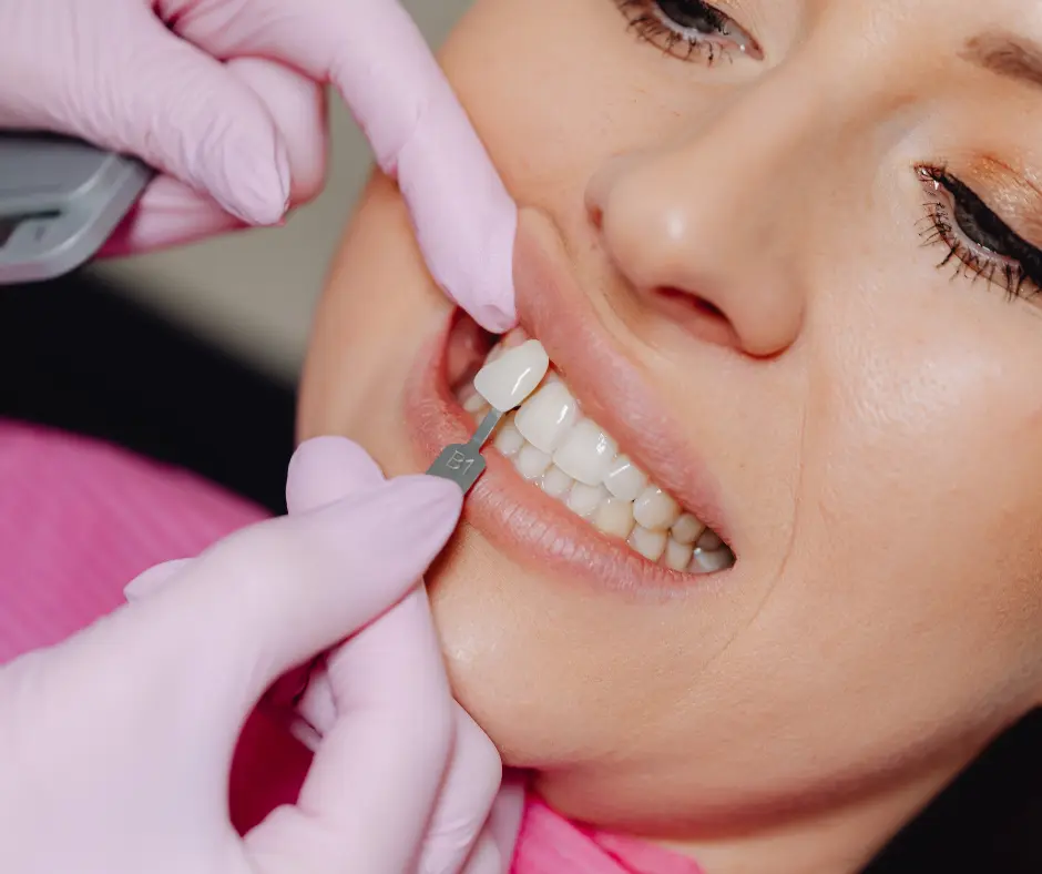 Dentist applying veneer to prepared tooth